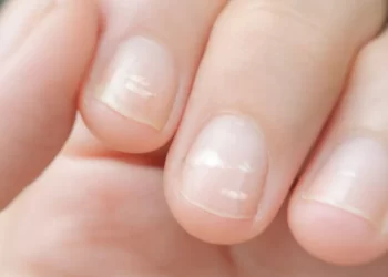 manchas en las uñas